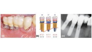 Articulo de investigacion Influencia-de-la-mucosa-queratinizada-en-implantes-tratados-de-periimplantitis