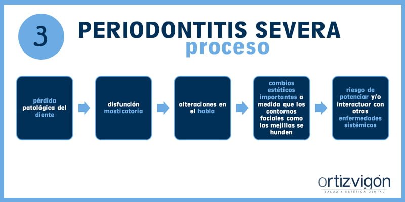 Periodontitis severa: el abc de las enfermedades periodontales