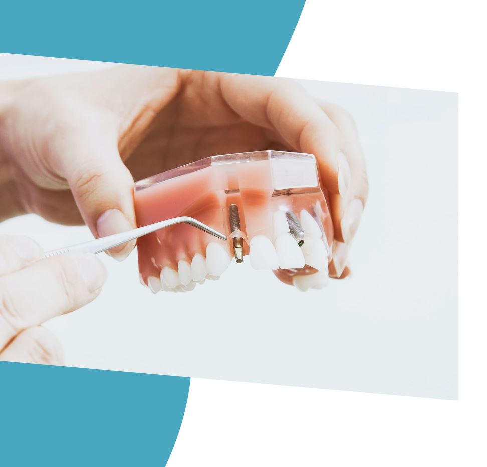 Implantes dentales en pacientes con periodontitis