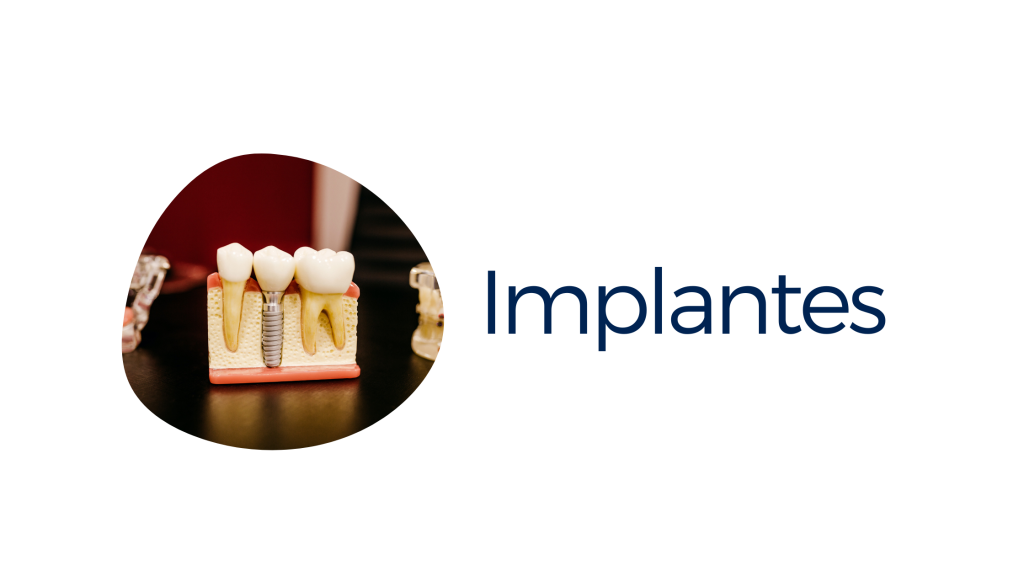 Cuida tus encías: implantes